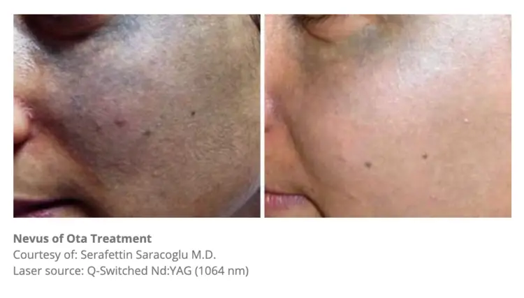 Laser Pigmentation Removal Melbourne